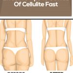 Effective Tips To Get Rid Of Cellulite Fast