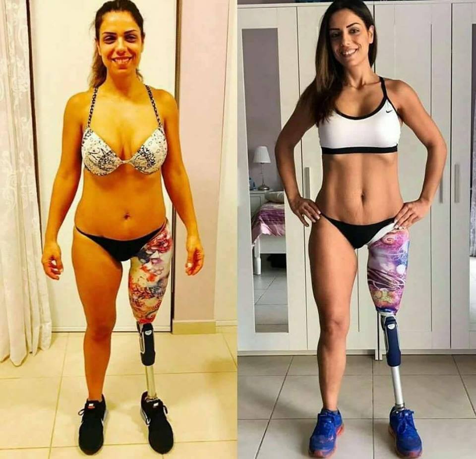 the girl lost her leg but have willpower, and remains in shape