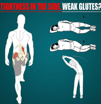 TIGHTNESS IN THE SIDE, WEAK GLUTE MED?