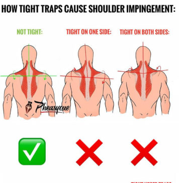 💪TIGHT UPPER TRAPS & SHOULDER IMPINGEMENT👇