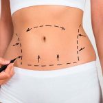 lose weight liposuction
